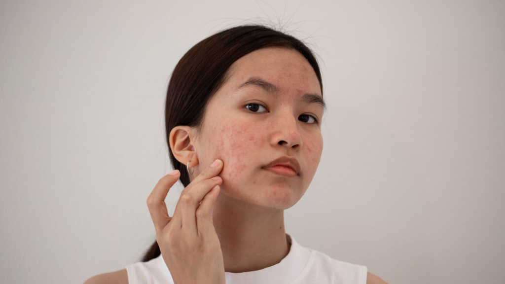 hormonal cystic acne